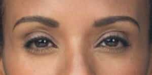 After Image: Botox/Xeomin/Dysport