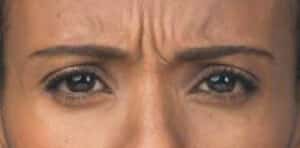 Before Image: Botox/Xeomin/Dysport