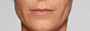 After Image: Fillers