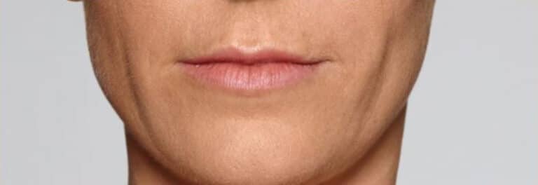After Image: Fillers - front