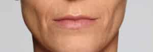 Before Image: Fillers