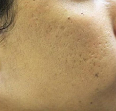 After Image: Microneedling - right-front-oblique