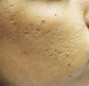 Before Image: Microneedling