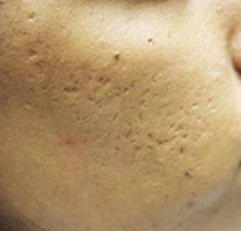 Before Image: Microneedling - right-front-oblique