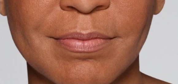 After Image: Fillers - front