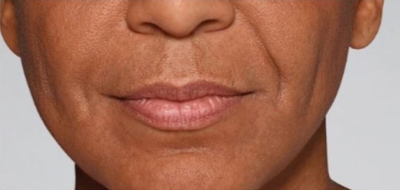 Before Image: Fillers - front