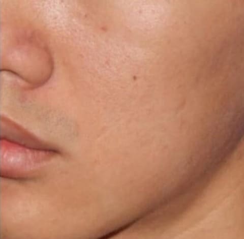 After Image: Microneedling - left-front-oblique