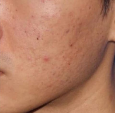 Before Image: Microneedling - left-front-oblique