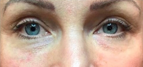 After Image: Fillers - front