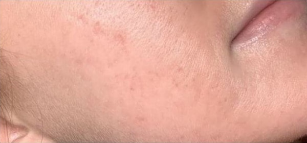 After Image: Microneedling - right-front-oblique