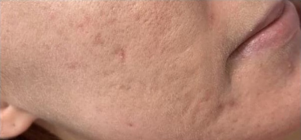 Before Image: Microneedling - right-front-oblique