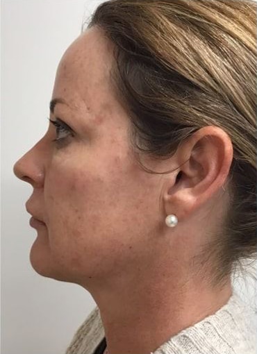 After Image: Fillers - left-side