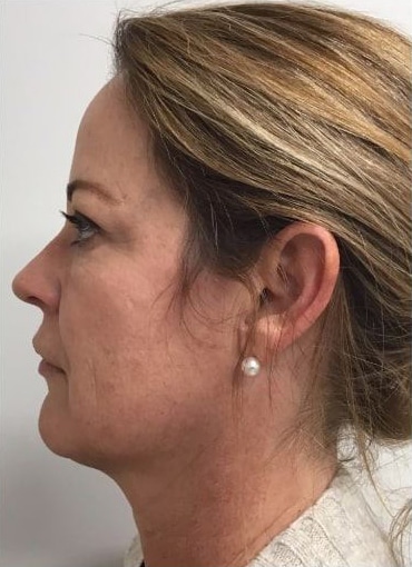 Before Image: Fillers - left-side