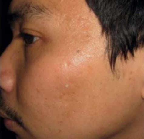 After Image: Microneedling - left-front-oblique
