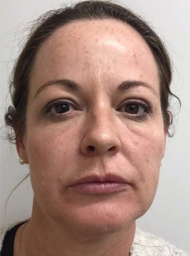 After Image: Fillers - front