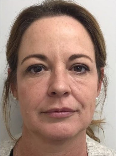 Before Image: Fillers - front