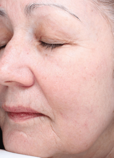 After Image: Fractional Laser - left-front-oblique