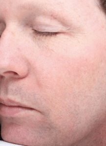 After Image: Fractional Laser