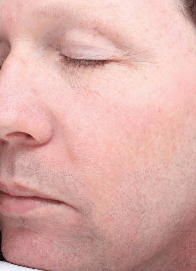 After Image: Fractional Laser - left-front-oblique