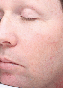Before Image: Fractional Laser