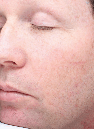 Before Image: Fractional Laser - left-front-oblique