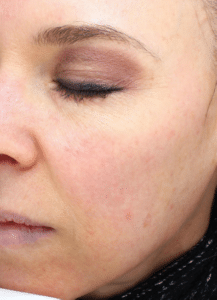 Before Image: Fractional Laser
