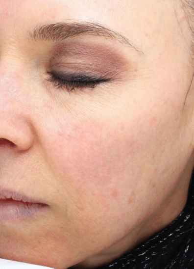 Before Image: Fractional Laser - left-front-oblique