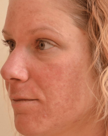 Before Image: Fractional Laser - left-front-oblique