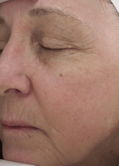 After Image: Fractional Laser - left-front-oblique