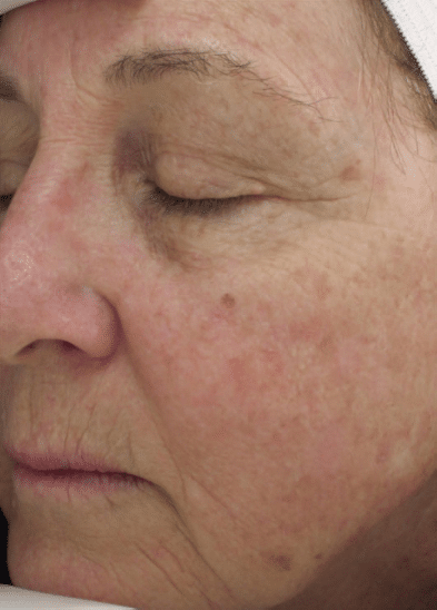 Before Image: Fractional Laser - left-front-oblique
