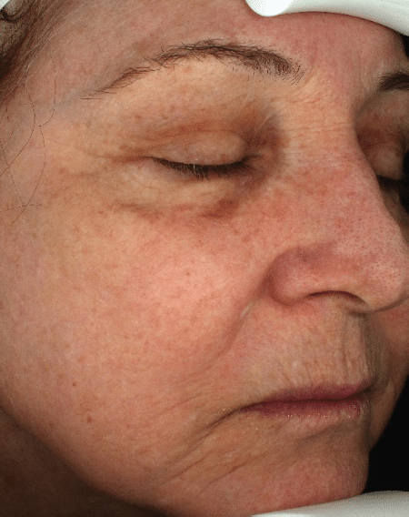 After Image: Fractional Laser - right-front-oblique