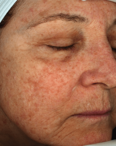 Before Image: Fractional Laser - right-front-oblique