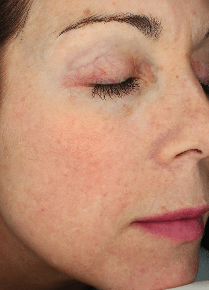 After Image: Fractional Laser - right-front-oblique
