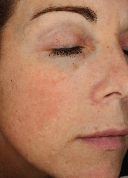 Before Image: Fractional Laser - right-front-oblique