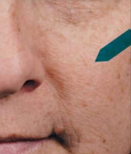 After Image: Chemical Peels