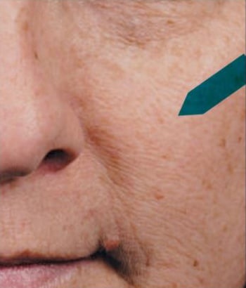 After Image: Chemical Peels - front