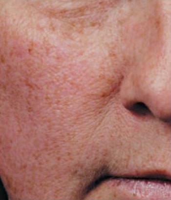 Before Image: Chemical Peels - front