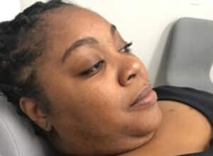 Before Image: Dermaplaning