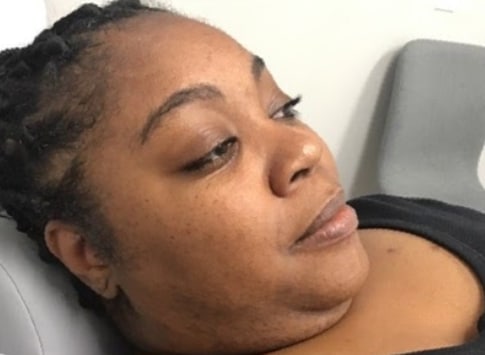 Before Image: Dermaplaning - right-front-oblique