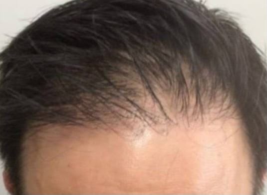 Before Image: Hair Restoration - front