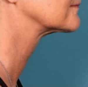 Kybella