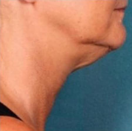 Before Image: Kybella - right-side