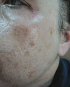 Before Image: Laser Treatments