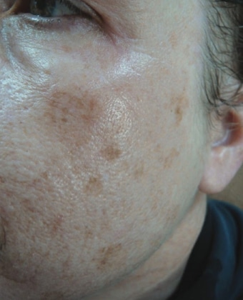 Before Image: Laser Treatments - left-front-oblique