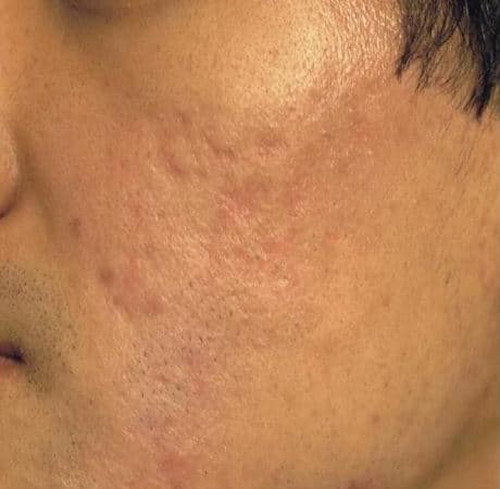 After Image: Laser Resurfacing - left-front-oblique