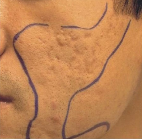 Before Image: Laser Resurfacing - left-front-oblique