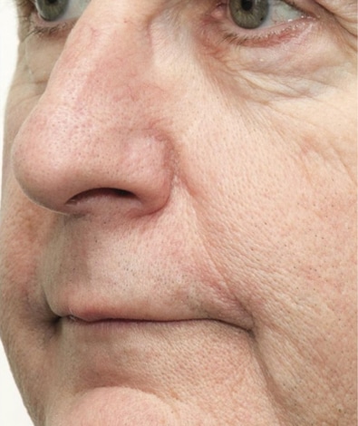 After Image: Laser Treatments - left-front-oblique