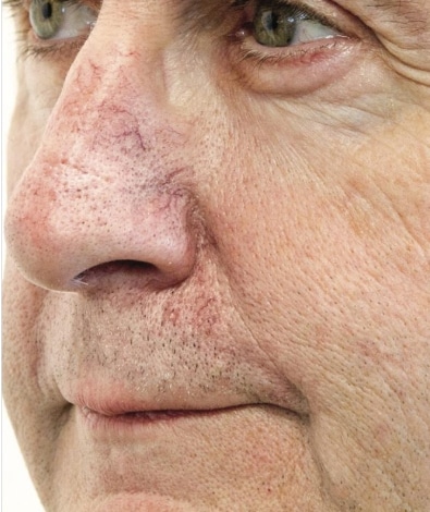 Before Image: Laser Treatments - left-front-oblique