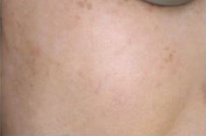 After Image: Laser Treatments - right-front-oblique