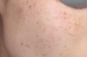 Before Image: Laser Treatments - right-front-oblique